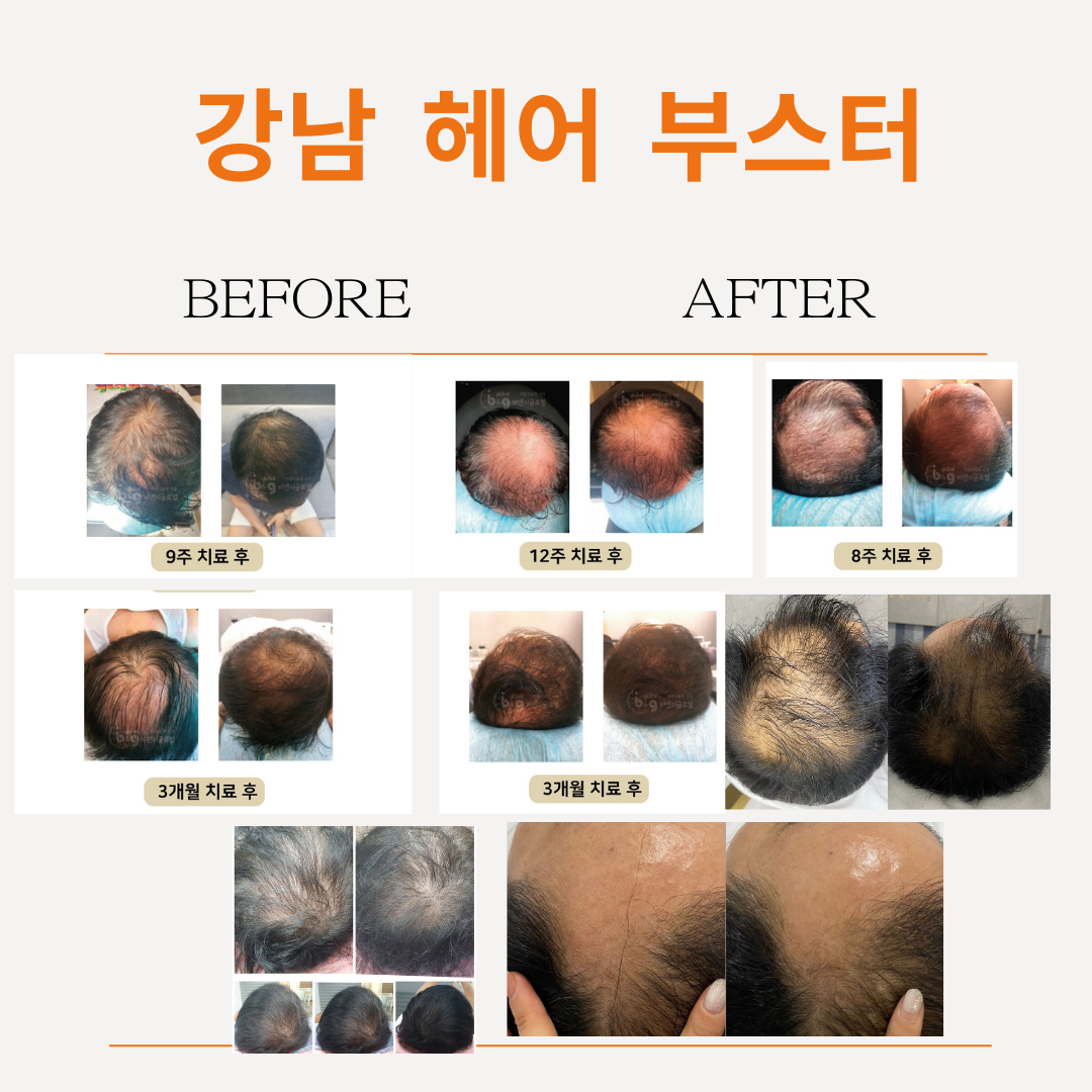 강남 헤어부스터 (Hair loss management)